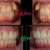 叢生を矯正した治療前後の歯並びの比較