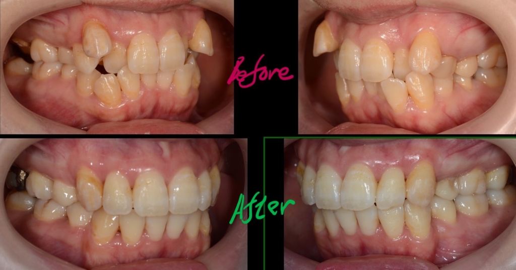 叢生を矯正した治療前後の歯並びの比較