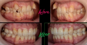 叢生を矯正した治療前後の歯並びの比較