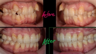 叢生を矯正した治療前後の歯並びの比較