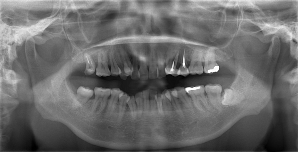 叢生(デコボコ)の矯正前の顎全体のレントゲン写真