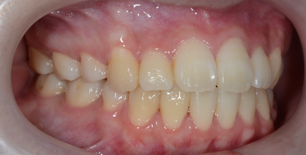 デコボコで口ゴボの矯正後の歯並び