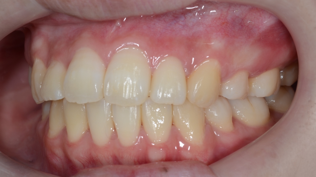 デコボコで口ゴボの矯正後の歯並び