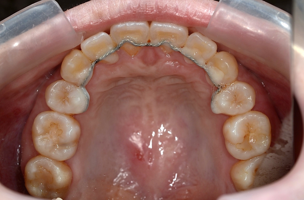 デコボコで口ゴボの矯正後の歯並び