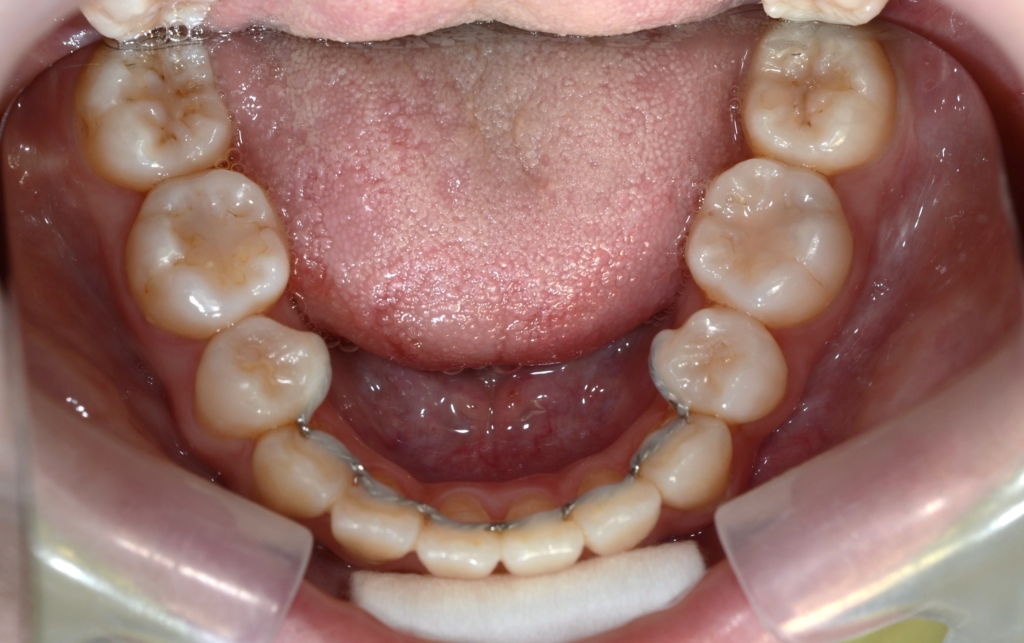 デコボコで口ゴボの矯正後の歯並び