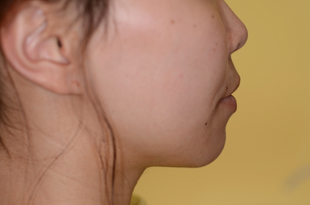 デコボコで口ゴボの矯正後の横顔と口元