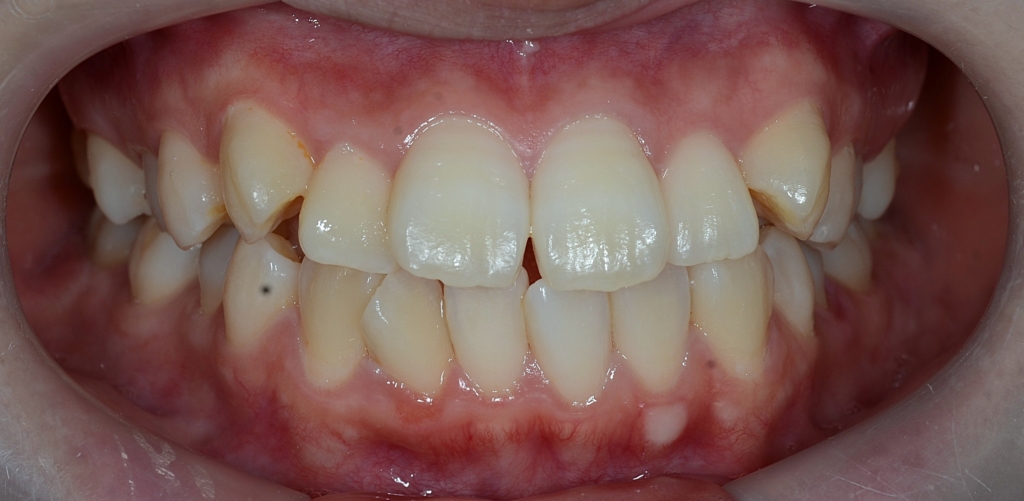 デコボコで口ゴボの矯正前の歯並び
