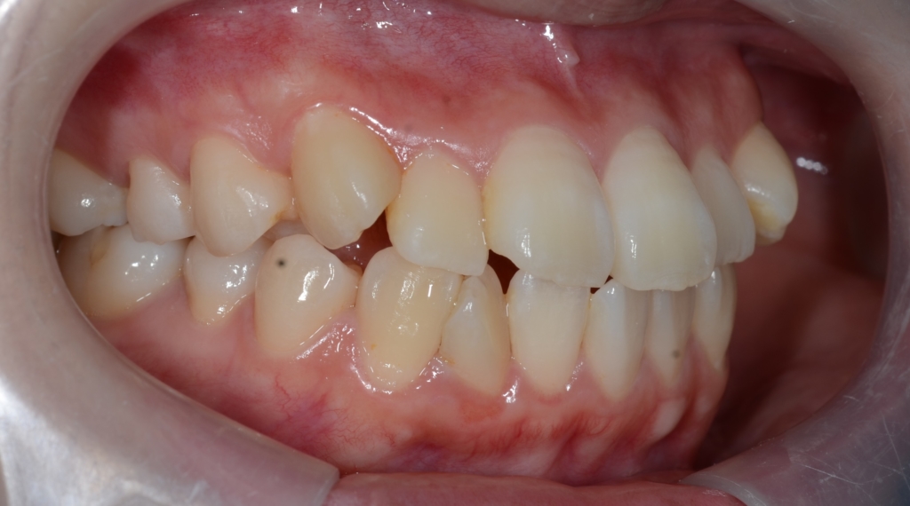 デコボコで口ゴボの矯正前の歯並び