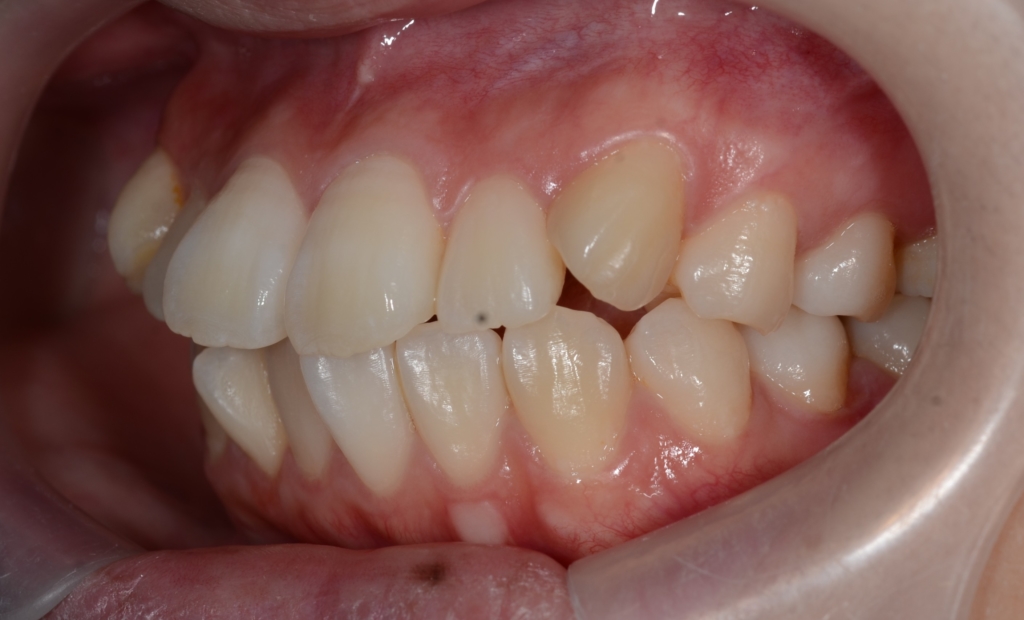 デコボコで口ゴボの矯正前の歯並び