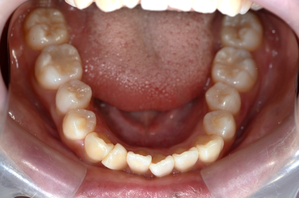 デコボコで口ゴボの矯正前の歯並び