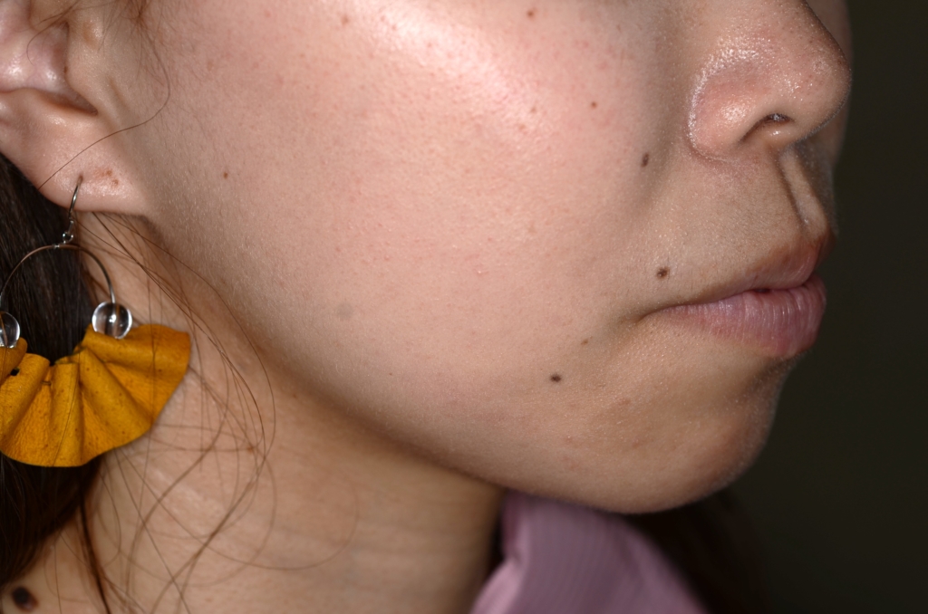 デコボコで口ゴボの矯正前の横顔と口元