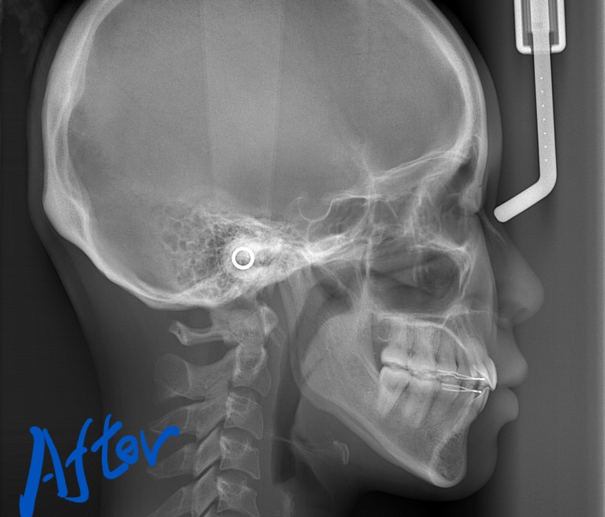 デコボコで口ゴボの矯正後の頭部を横から見たレントゲン写真