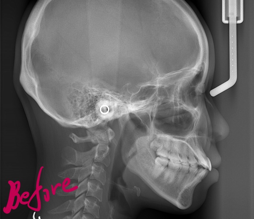 デコボコで口ゴボの矯正前の頭部を横から見たレントゲン写真
