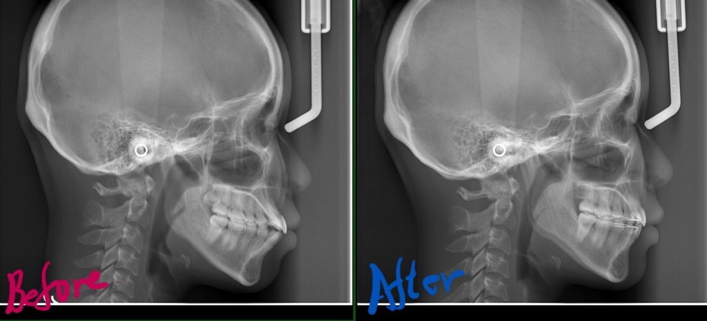 デコボコで口ゴボを矯正した治療前後のレントゲン写真による比較