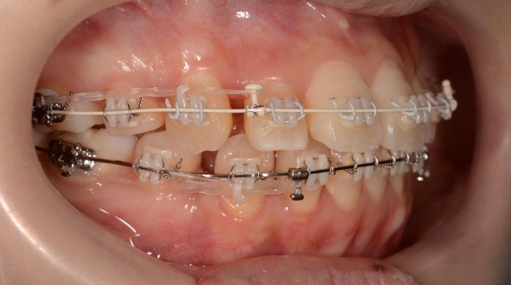 マルチブラケットシステムで矯正治療中
