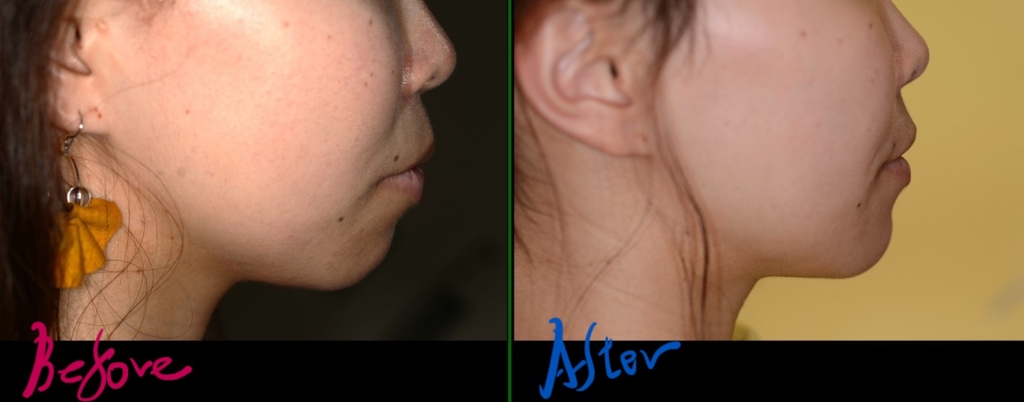 デコボコで口ゴボを矯正した治療前後の横顔と口元の変化の比較