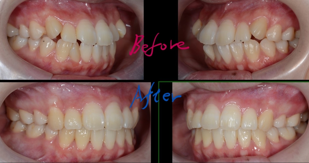 デコボコで口ゴボを矯正した治療前後の歯並びの変化の比較