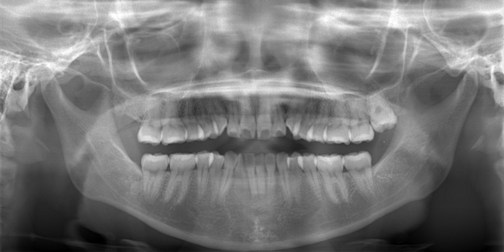 デコボコで口ゴボの矯正前の顎全体のレントゲン写真