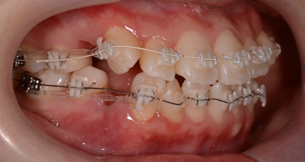 マルチブラケットシステムで矯正治療開始