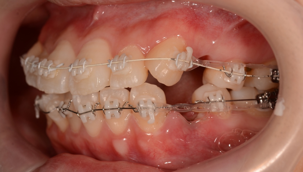 マルチブラケットシステムで矯正治療開始