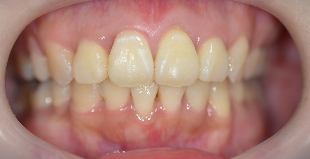 デコボコで出っ歯の矯正後の歯並び