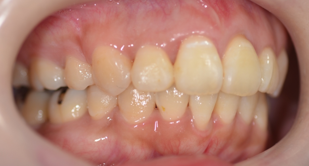 デコボコで出っ歯の矯正後の歯並び