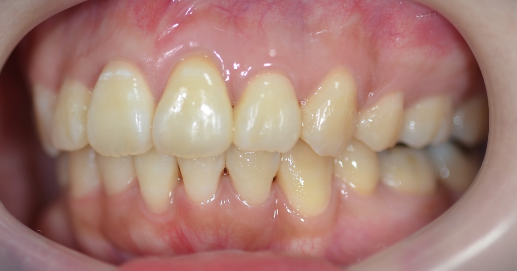 デコボコで出っ歯の矯正後の歯並び