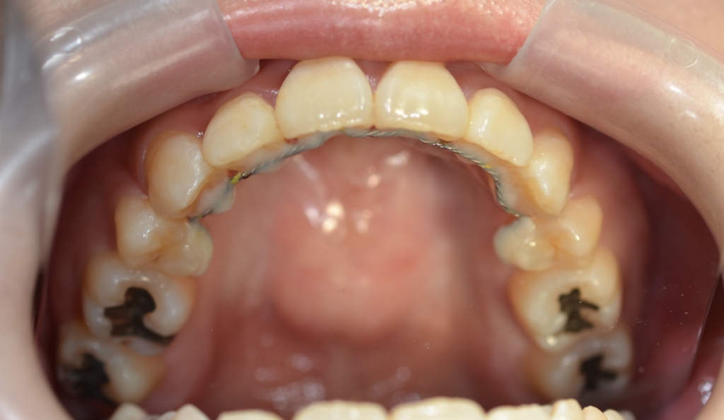 デコボコで出っ歯の矯正後の歯並び