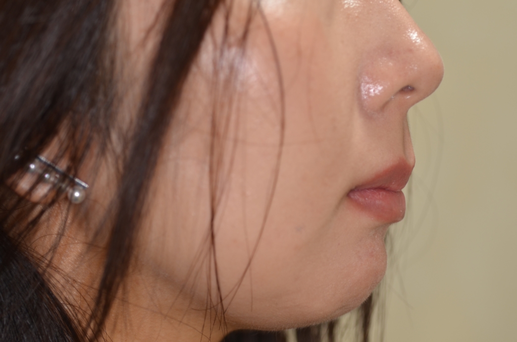 デコボコで出っ歯を矯正した後の横顔と口元