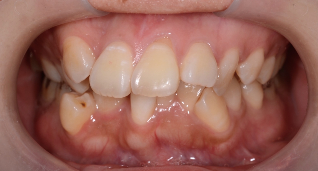 デコボコで出っ歯の矯正前の歯並び