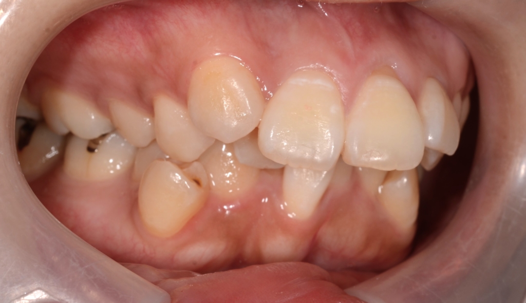 デコボコで出っ歯の矯正前の歯並び