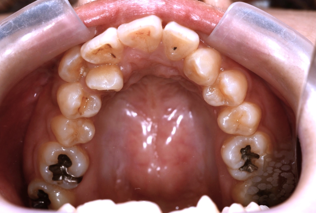 デコボコで出っ歯の矯正前の歯並び