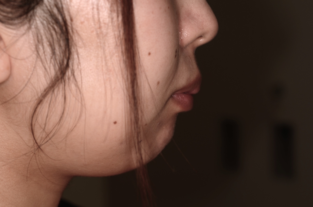 デコボコで出っ歯を矯正する前の横顔と口元