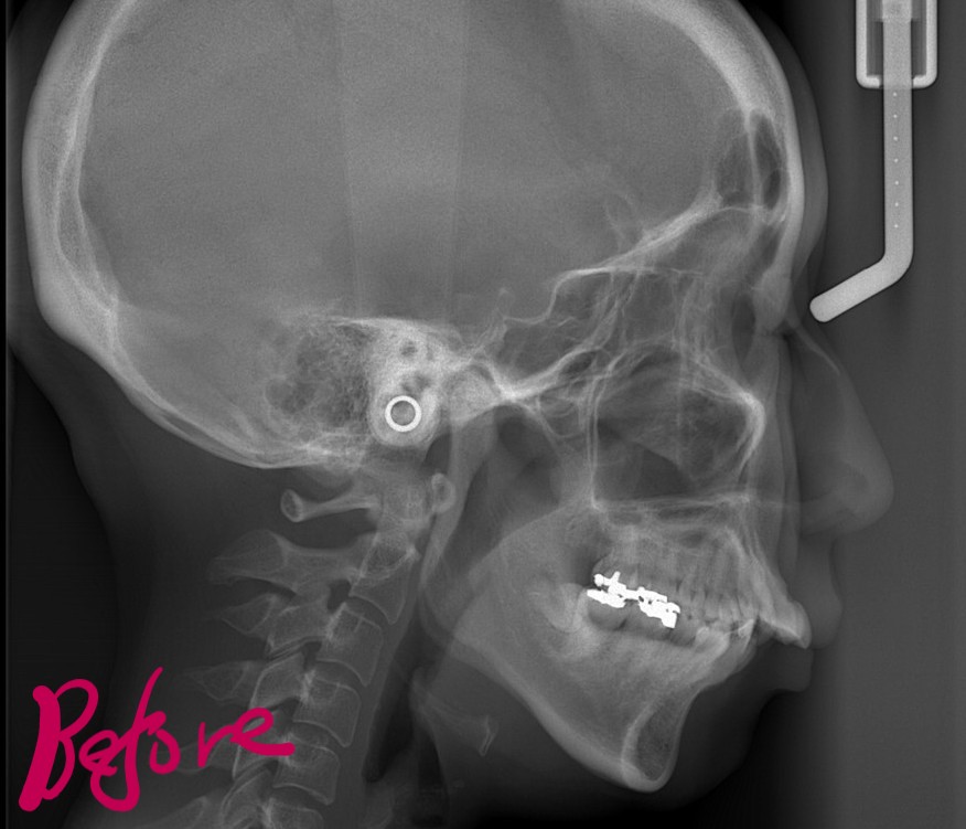 デコボコで出っ歯の矯正前の頭部を横から見たレントゲン写真