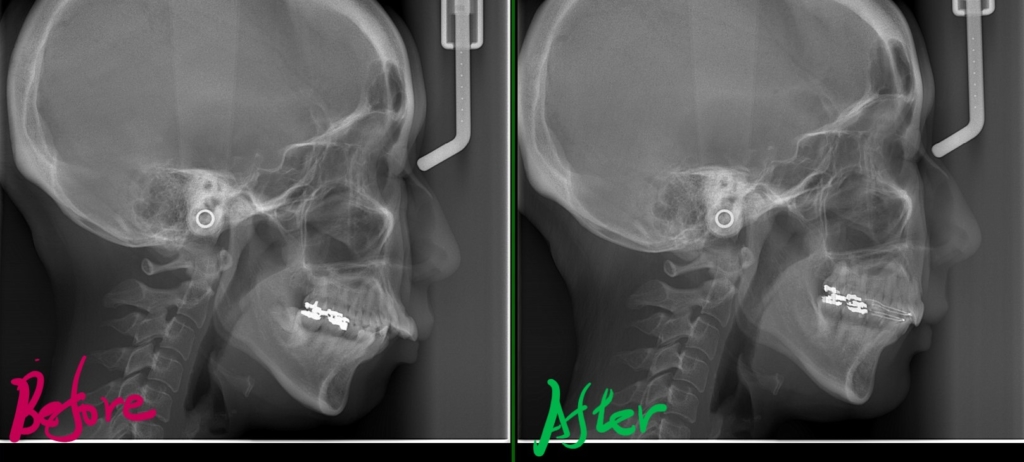 デコボコで出っ歯を矯正した治療前後のレントゲン写真による比較