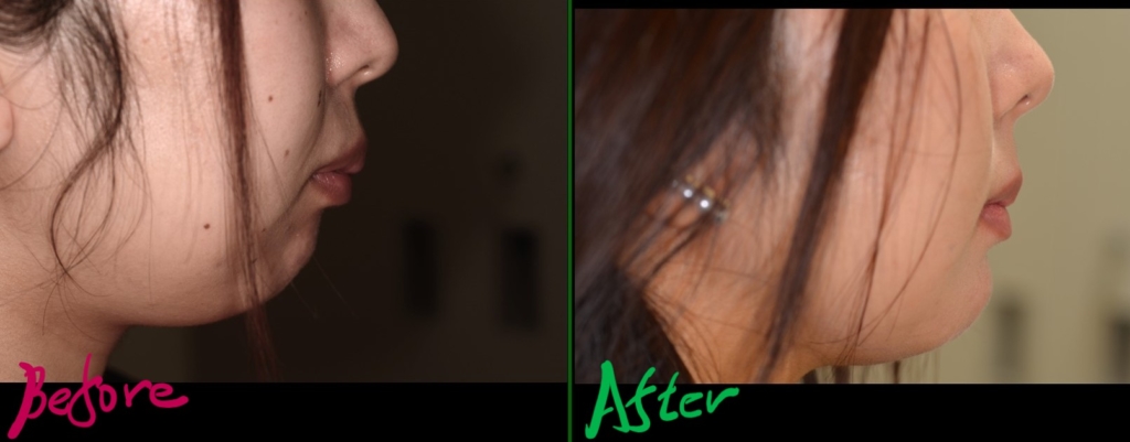 デコボコで出っ歯を矯正した治療前後の横顔と口元の変化の比較