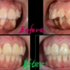 デコボコで出っ歯を矯正した治療前後の歯並びの変化の比較