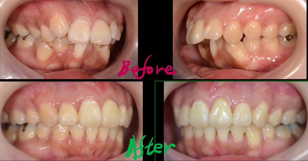 デコボコで出っ歯を矯正した治療前後の歯並びの変化の比較