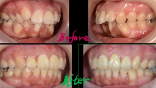 デコボコで出っ歯を矯正した治療前後の歯並びの変化の比較