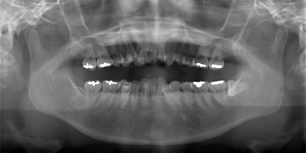 デコボコで出っ歯の矯正前の顎全体のレントゲン写真