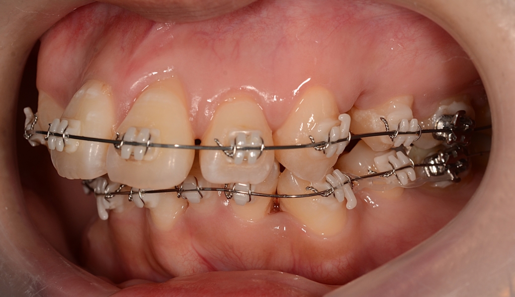 マルチブラケットシステムで矯正治療開始