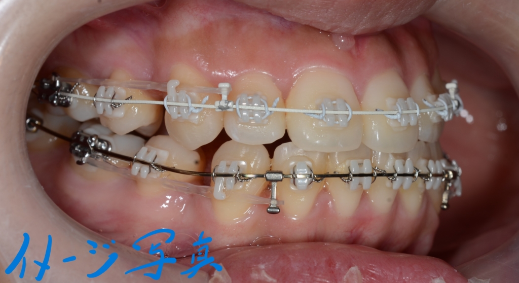 マルチブラケットシステムにて抜歯スペースを閉じている途中