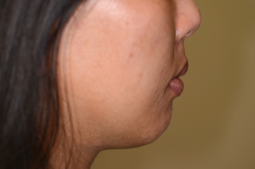 出っ歯でデコボコの矯正後の横顔と口元