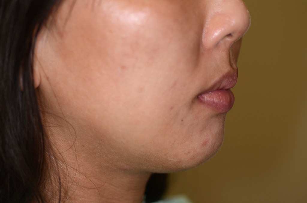 出っ歯でデコボコの矯正後の横顔と口元