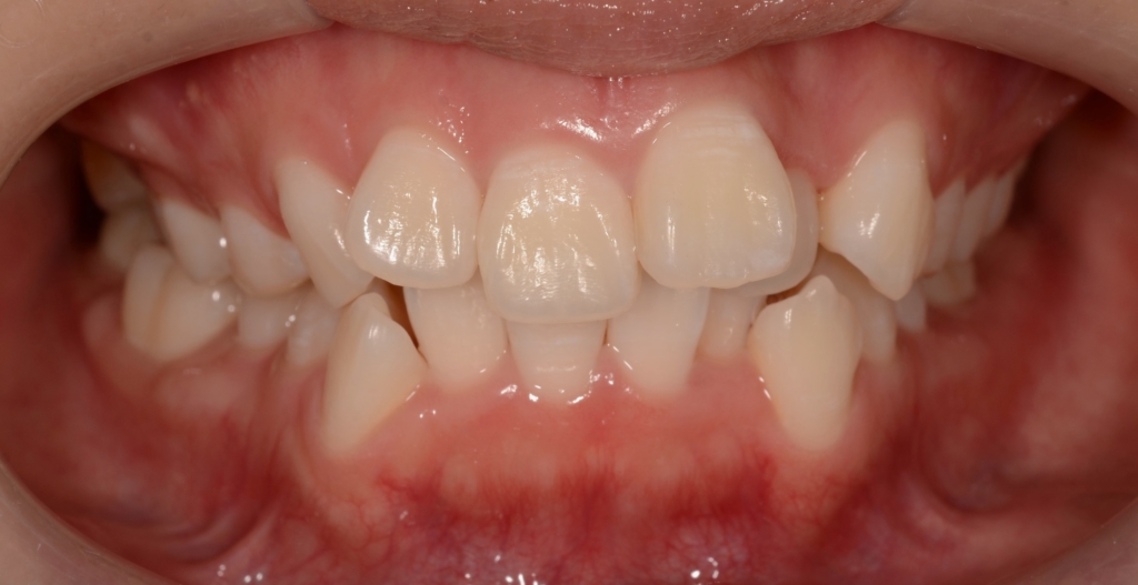 出っ歯でデコボコの矯正前の歯並び