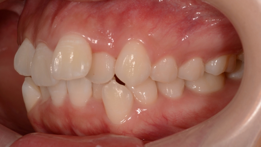 出っ歯でデコボコの矯正前の歯並び