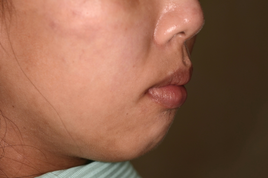 出っ歯でデコボコの矯正前の横顔と口元