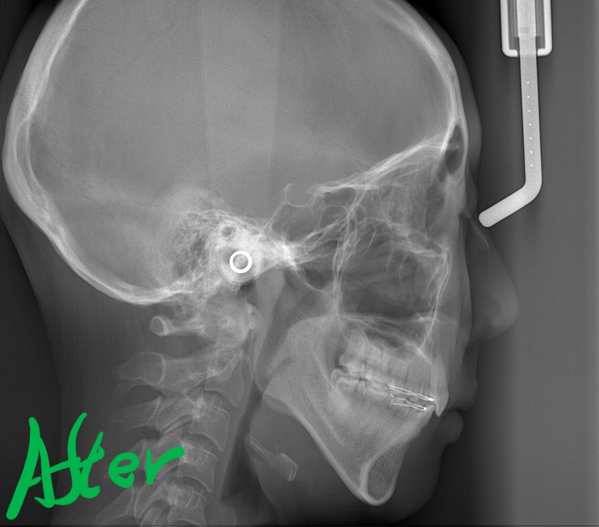 出っ歯でデコボコの矯正後の頭部を横から見たレントゲン写真