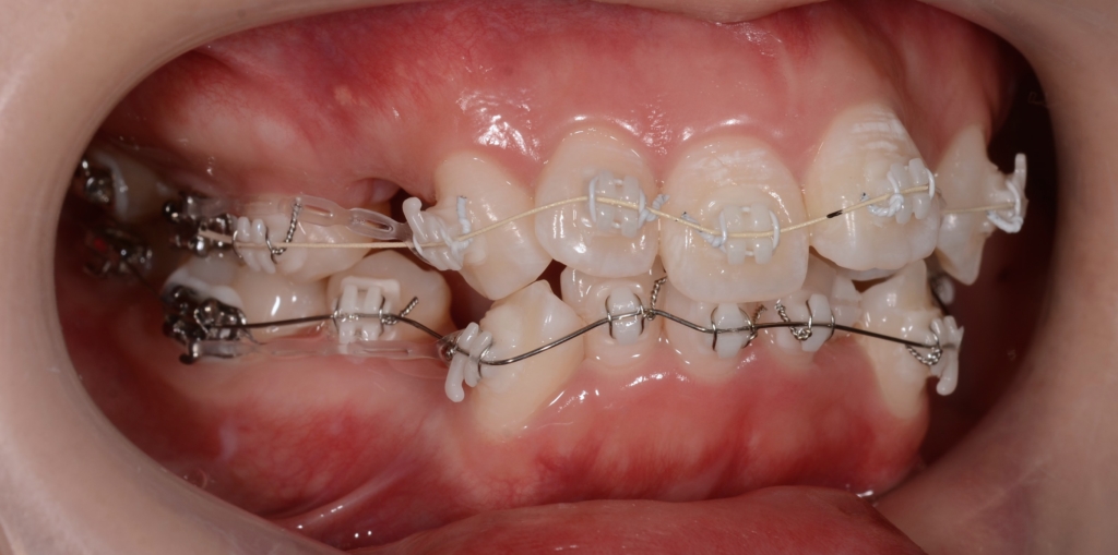 マルチブラケットシステムで矯正治療開始