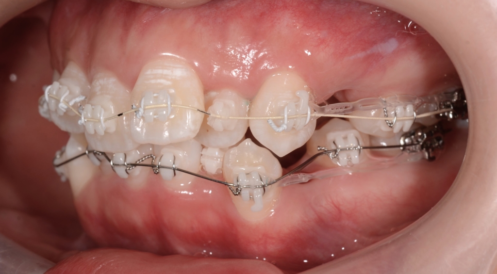 マルチブラケットシステムで矯正治療開始